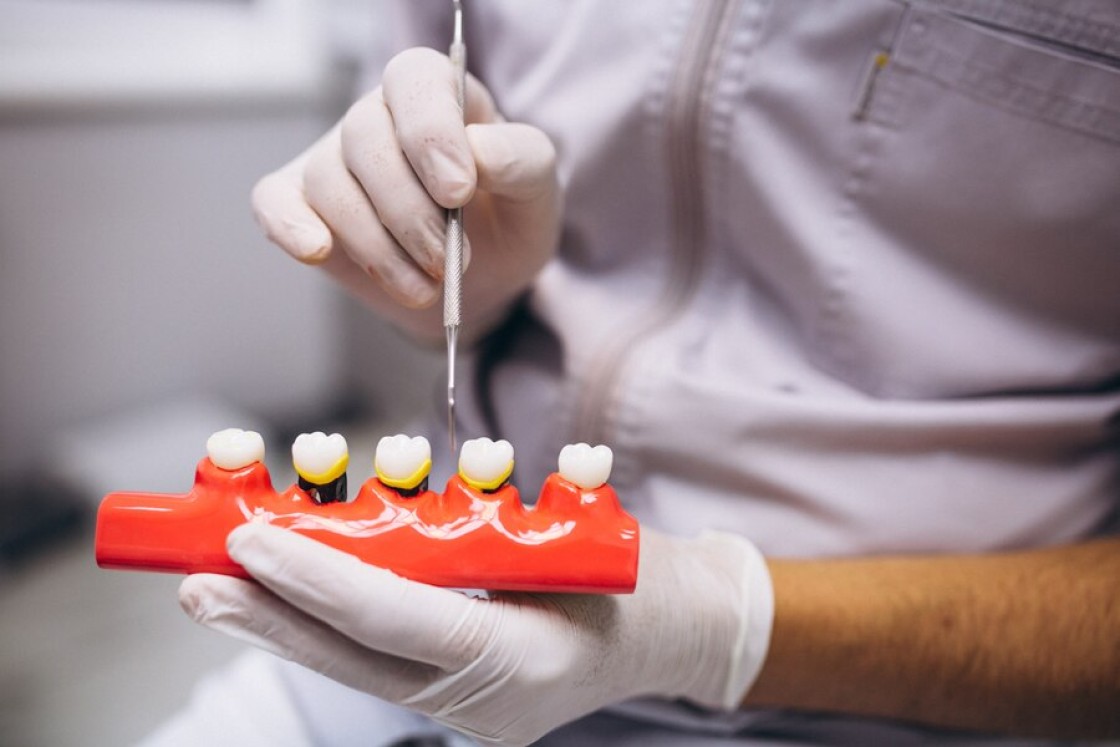 Claves para un cuidado efectivo de tus implantes dentales